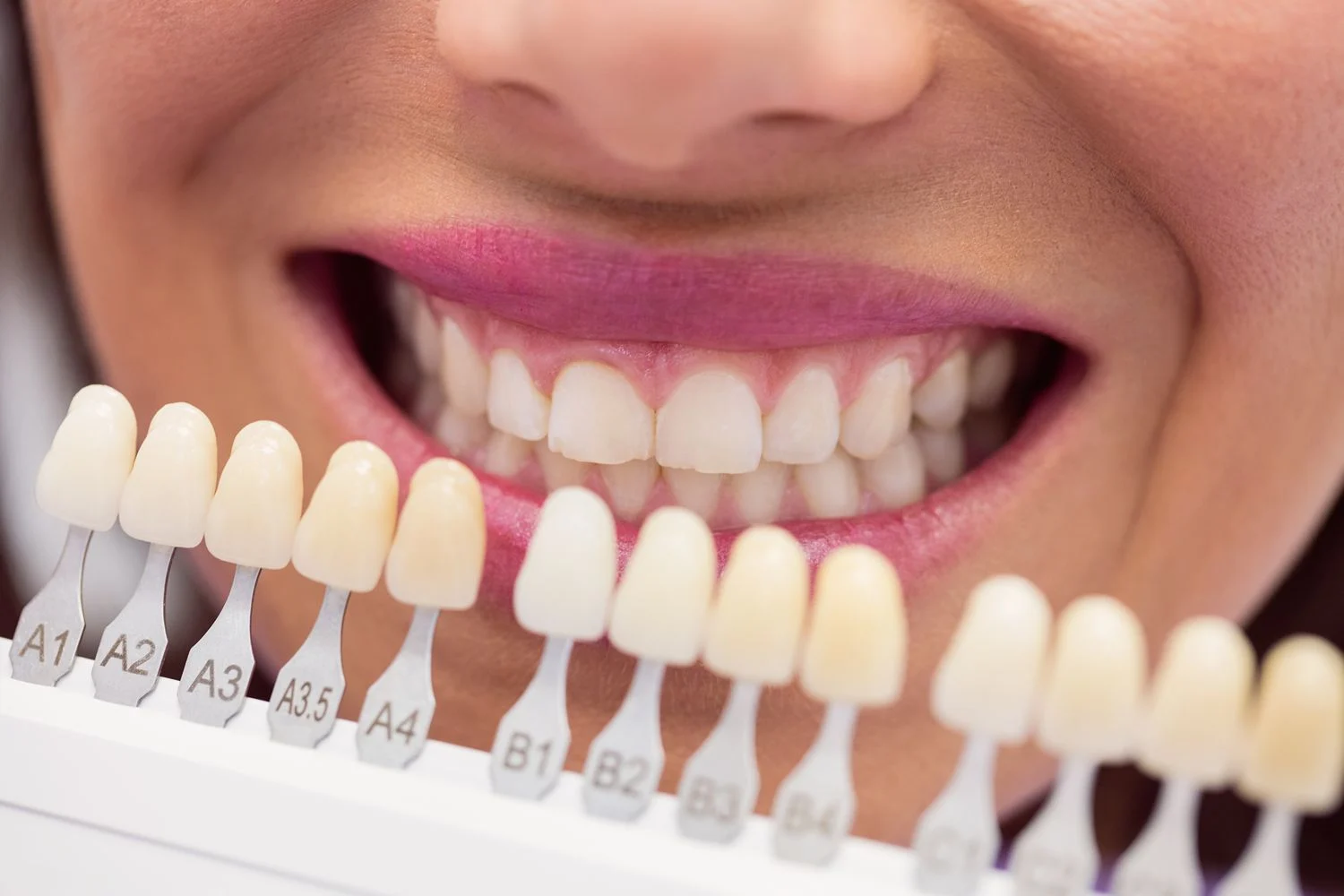 Dientes Mas Blancos 4 Dientes Mas Blancos 4