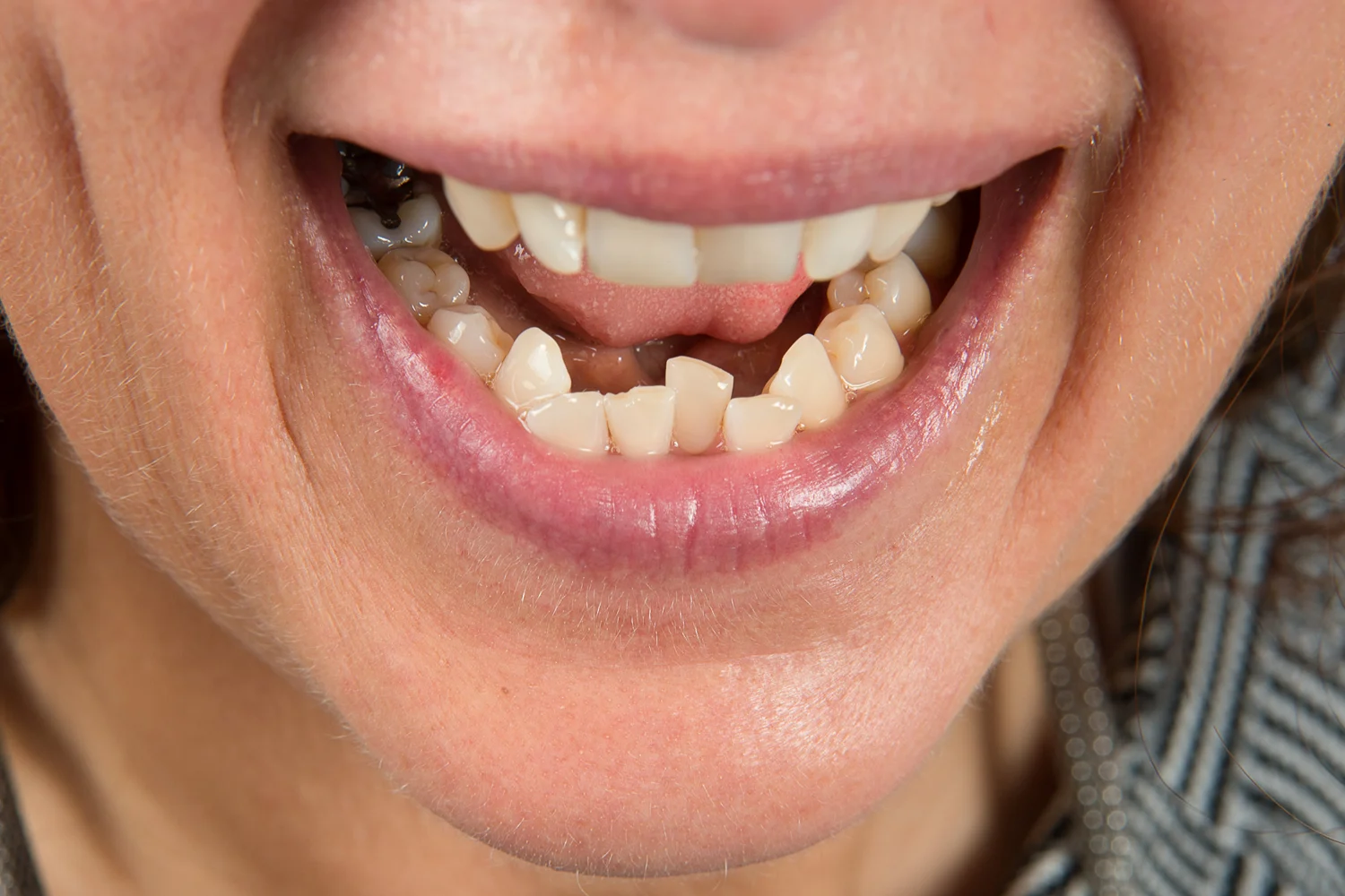 Clinica Dental Sitges Dents Tortes 0 Clinica Dental Sitges Dents Tortes 0