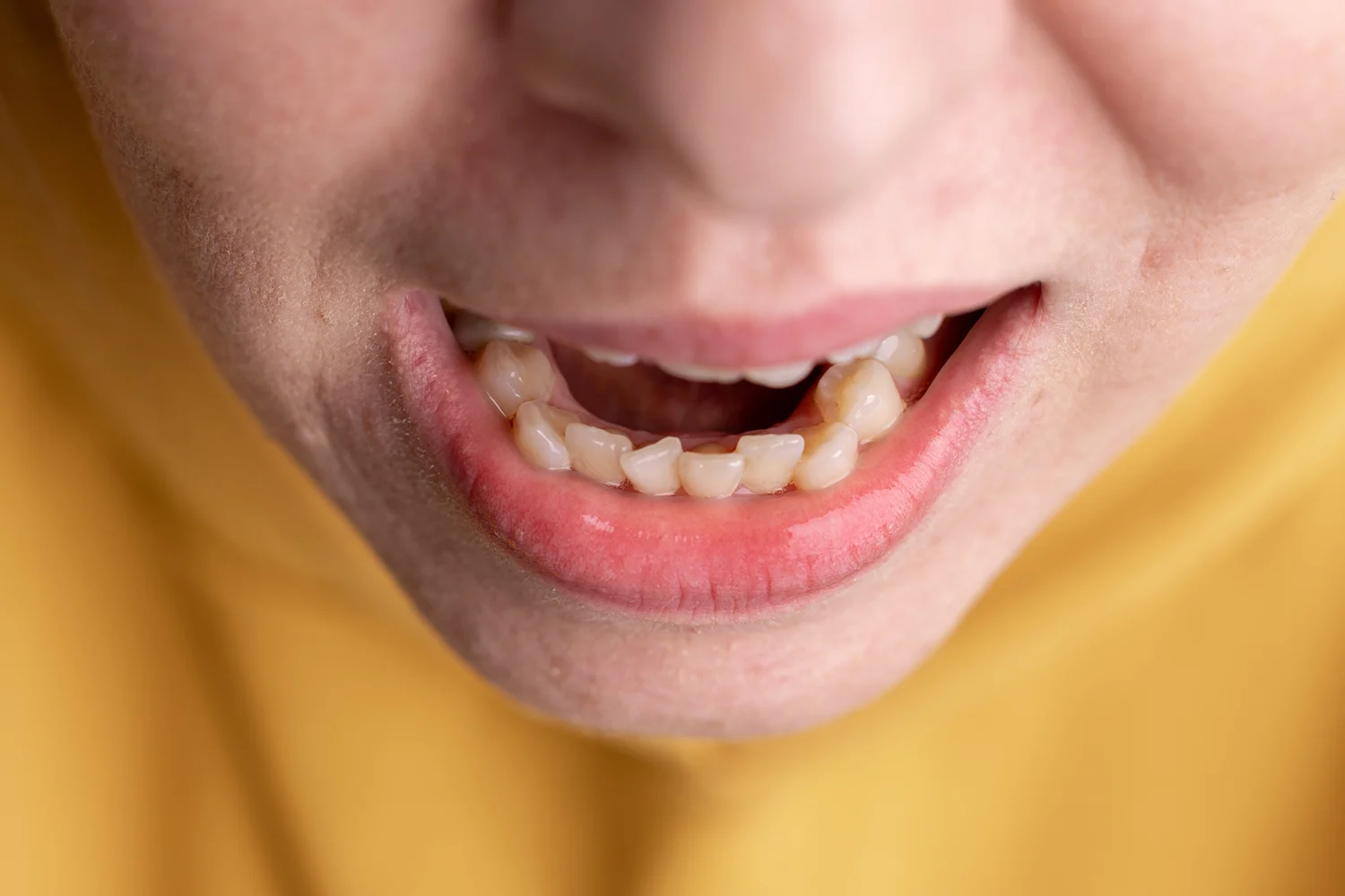 Clinica Dental Sitges Dents Tortes 2 Clinica Dental Sitges Dents Tortes 2