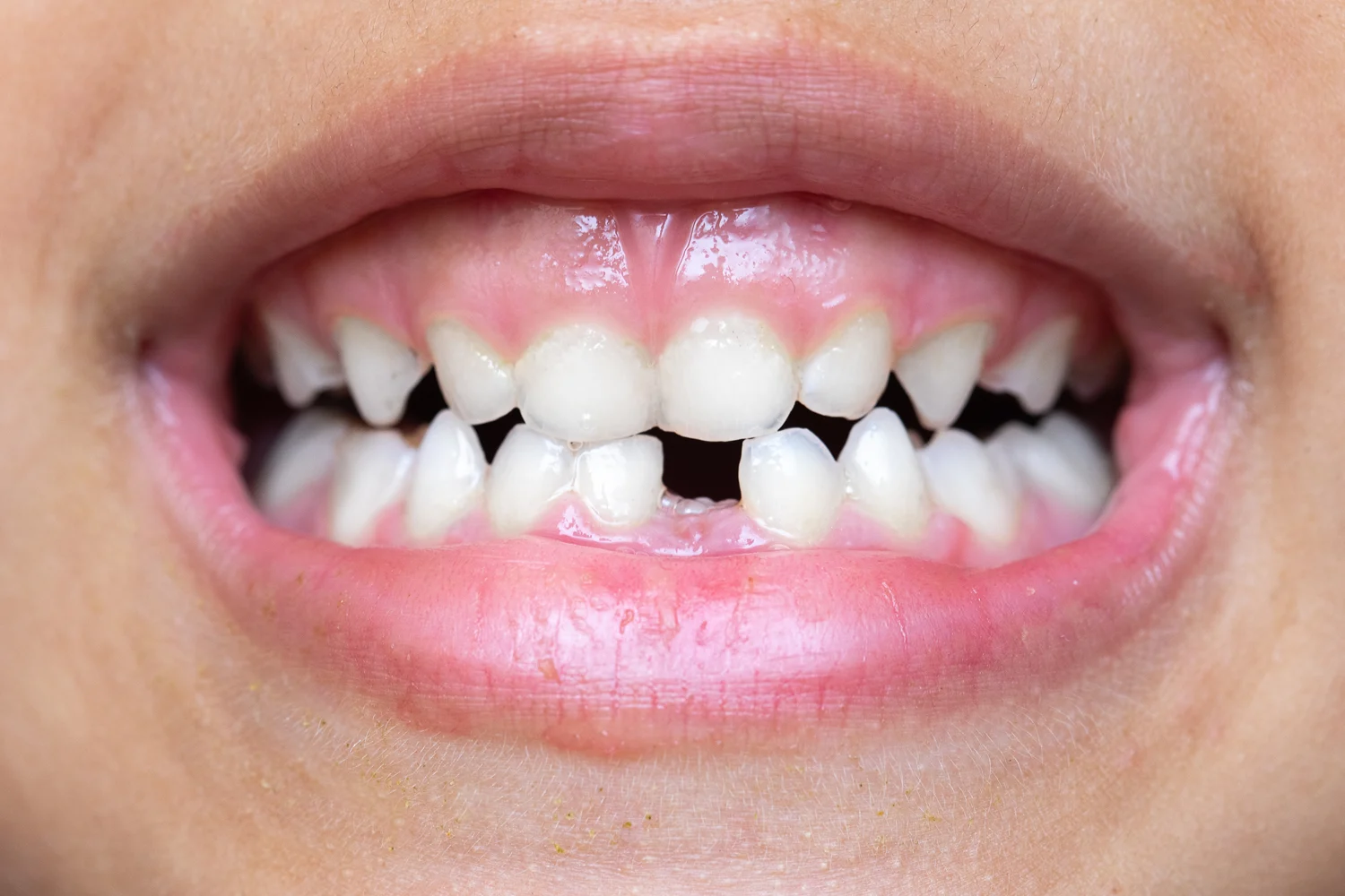 Clinica Dental Sitges Dents Tortes 3 Clinica Dental Sitges Dents Tortes 3