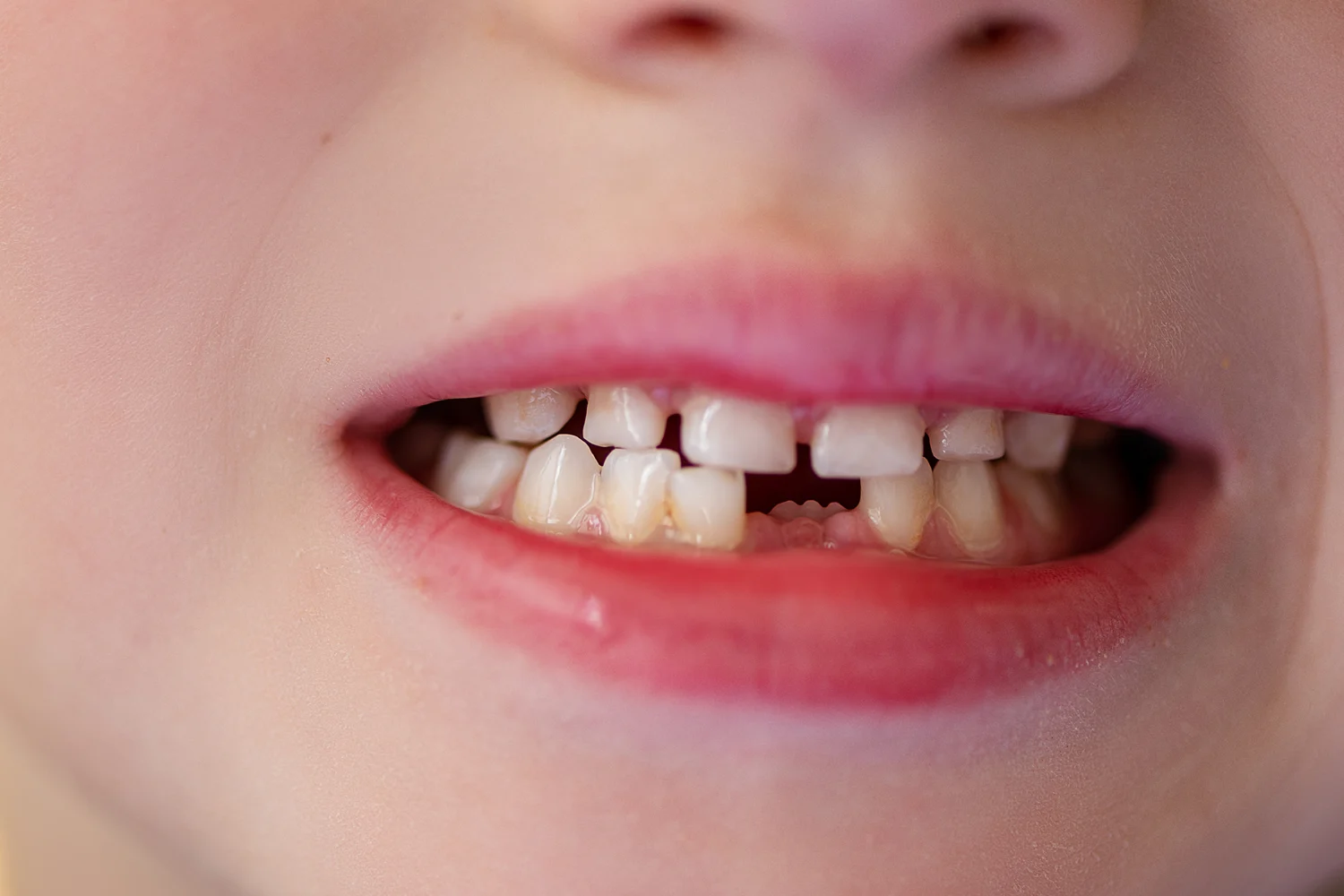 Clinica Dental Sitges Dents Tortes 4 Clinica Dental Sitges Dents Tortes 4