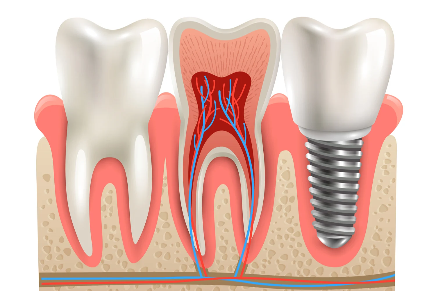 Clinica Dental Sitges Implantes Dentales 7 Clinica Dental Sitges Implantes Dentales 7